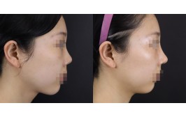 코재수술(연장,들린코교정 / 콧대-실리콘, 코끝-귀연골,기증늑) 1개월차