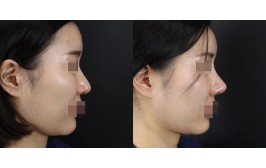 코재수술(긴코교정 / 콧대-실리콘, 코끝-기존연골,자가늑) 3개월차
