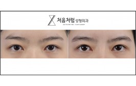 처음처럼 눈수술  절개눈매교정, 트임(앞,뒤,밑) 3개월