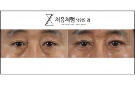 상하안검 / 수술 후 3개월