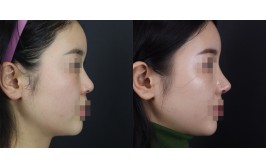 코수술(연장 / 콧대-실리콘, 코끝-비중격,귀연골) 2주차