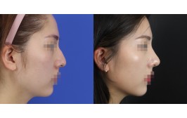 무보형물 코수술(매부리코 / 콧대-X, 코끝-귀연골) 수술 후 3개월