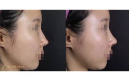 코재수술(콧대-실리콘, 코끝-기존기증늑,엉덩이진피) 1개월차