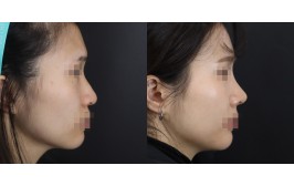 코수술(긴코교정 / 콧대-실리콘, 코끝-비중격,귀연골) 2개월차